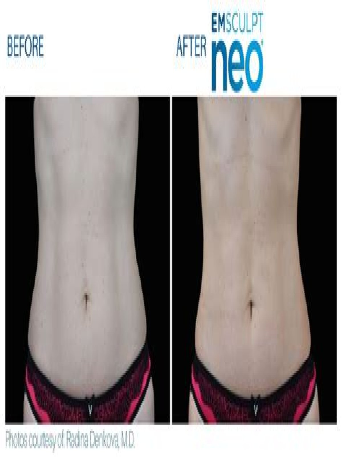 Can I do CoolSculpting and Emsculpt together?