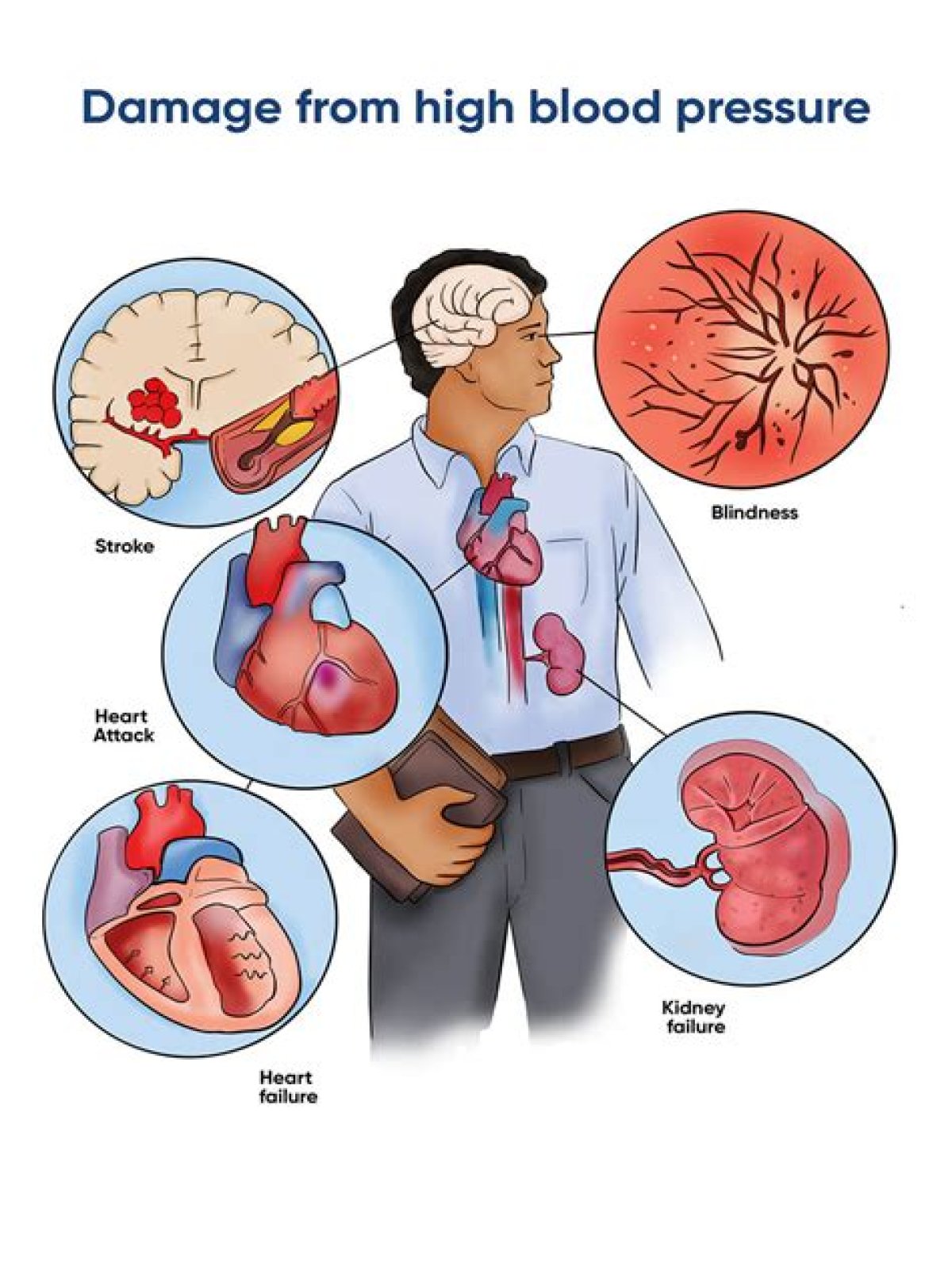 Can you reverse high blood pressure damage?