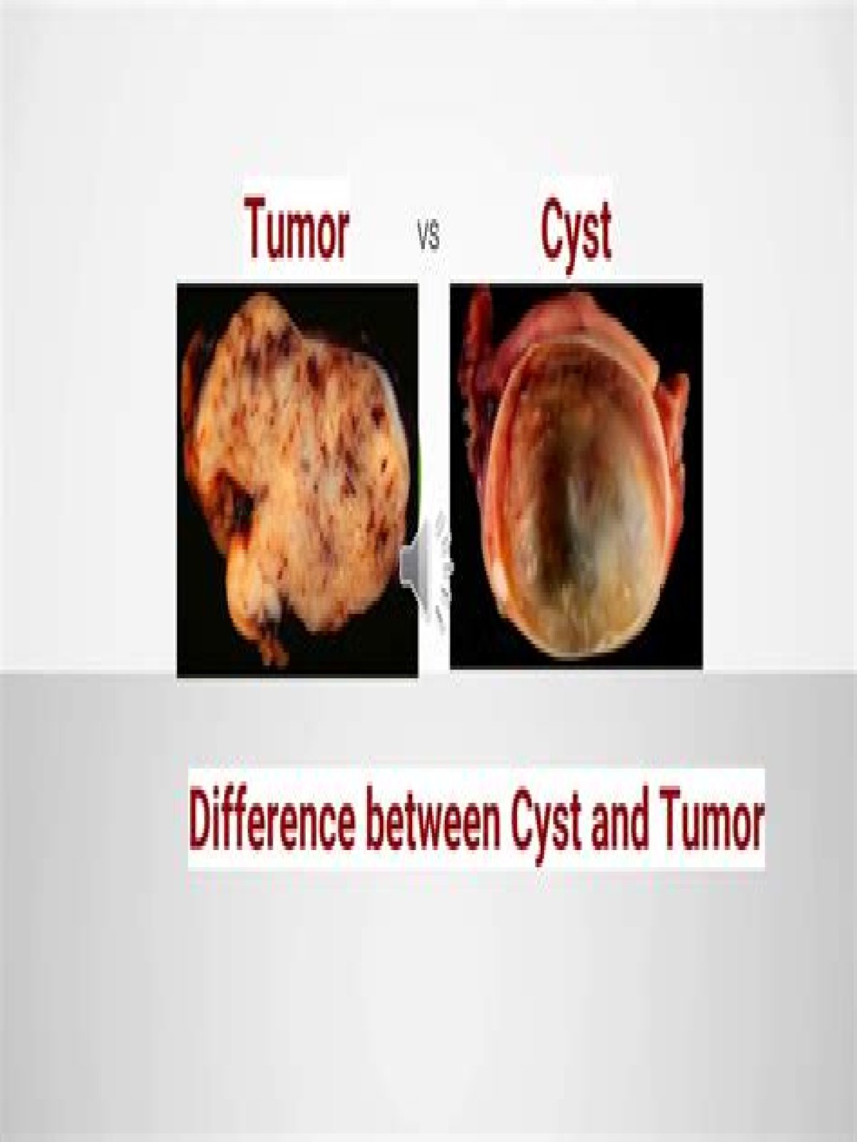 How can you tell if a cyst is cancerous?