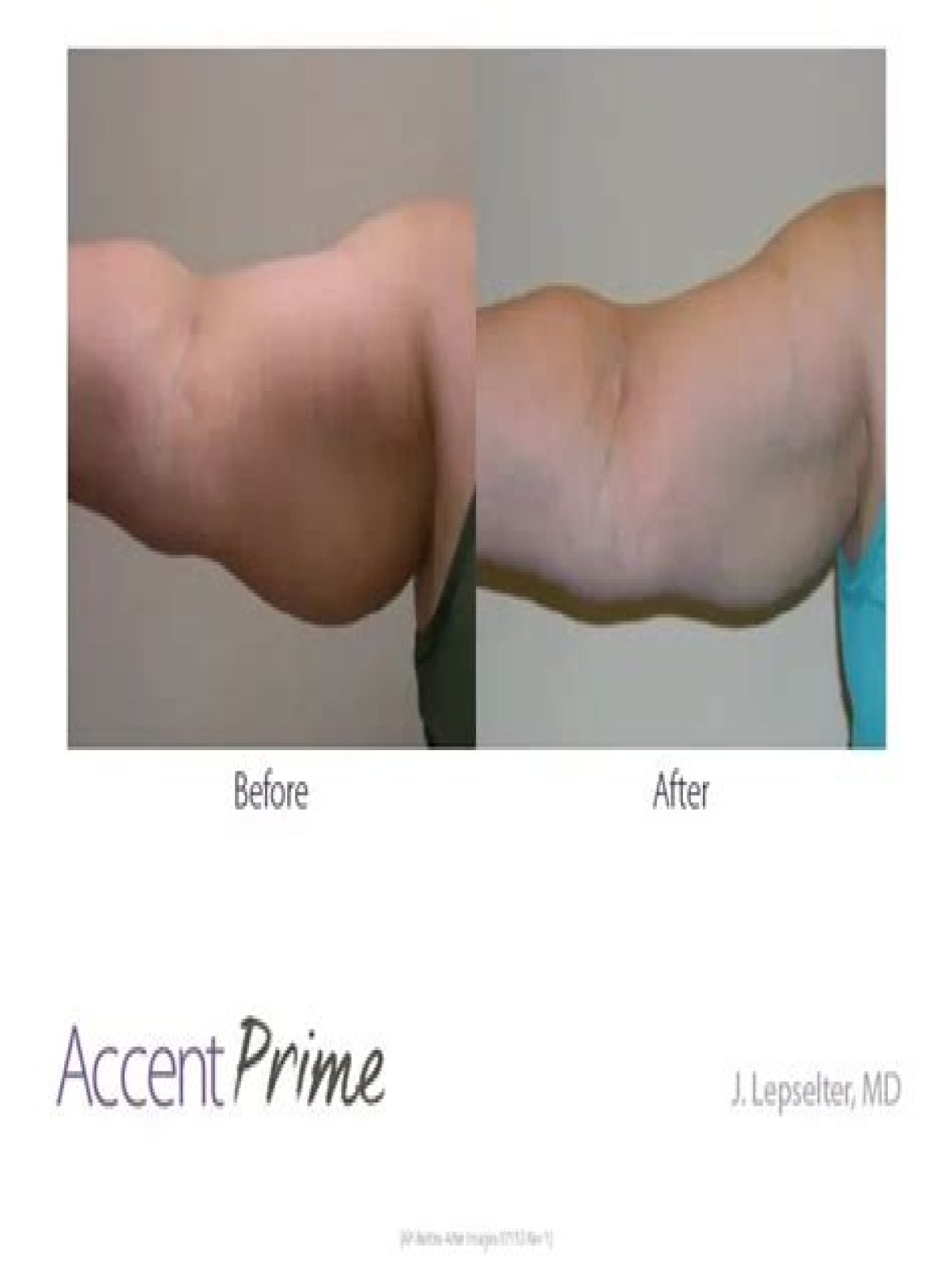 How much does non invasive body sculpting cost?