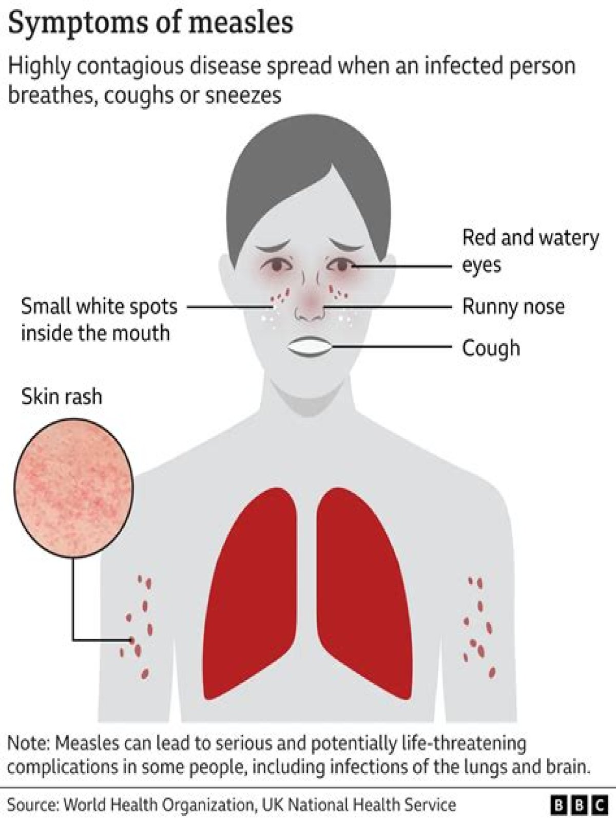 what are measles