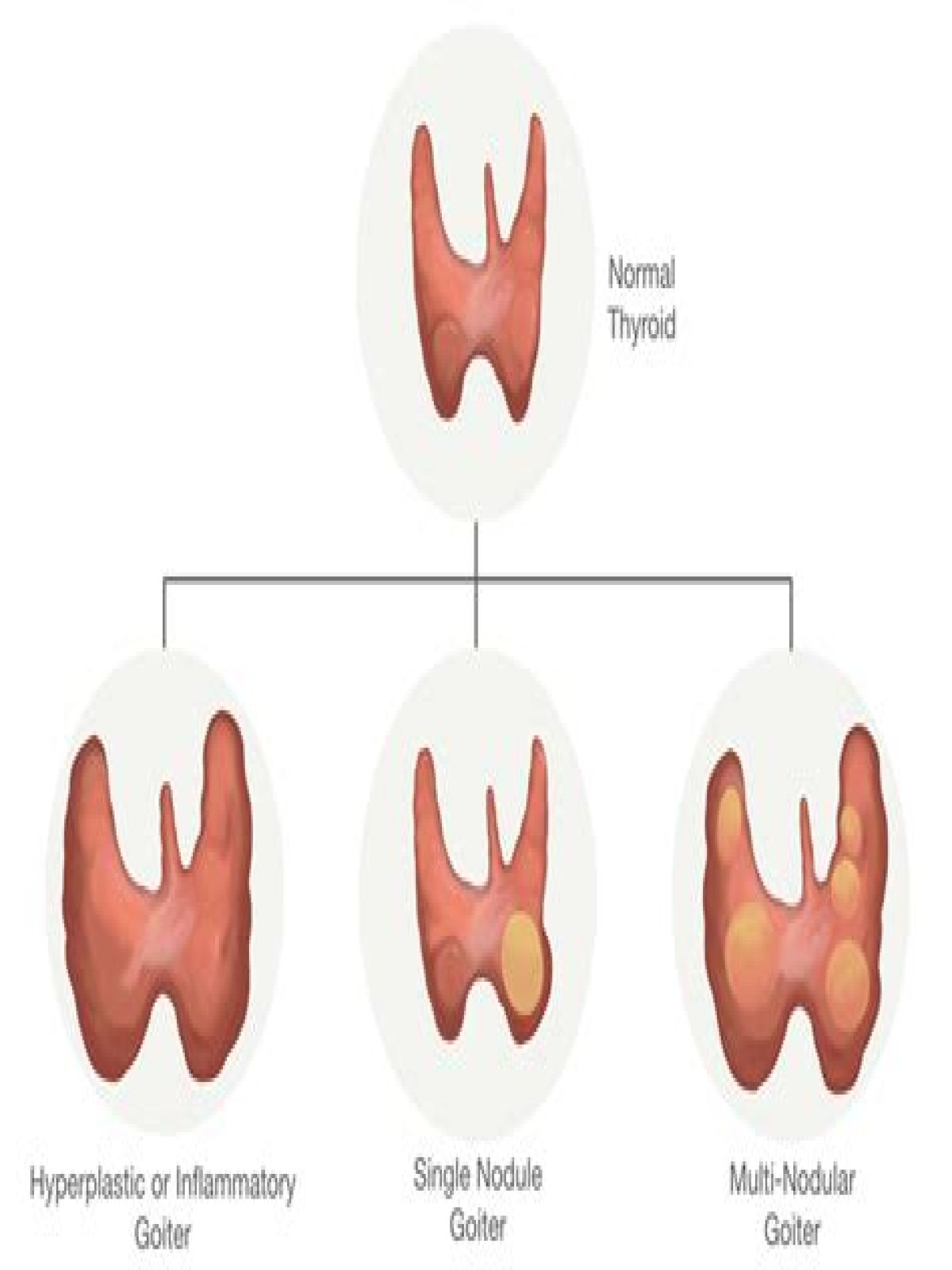What are the different types of goiters