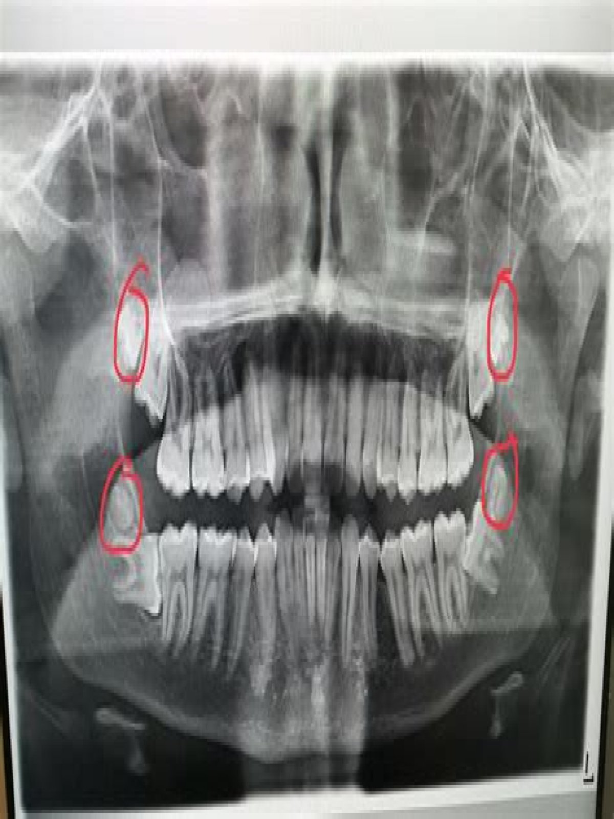 Why do I have 8 wisdom teeth?